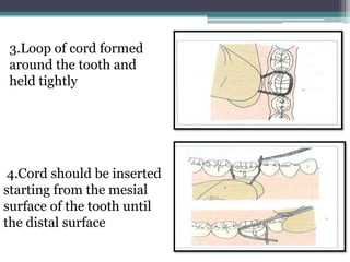 3.Loop of cord formed
around the tooth and
held tightly




 4.Cord should be inserted
starting from the mesial
surface of the tooth until
the distal surface
 