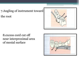 7.Angling of instrument toward
the root




 8.excess cord cut off
 near interproximal area
 of mesial surface
 