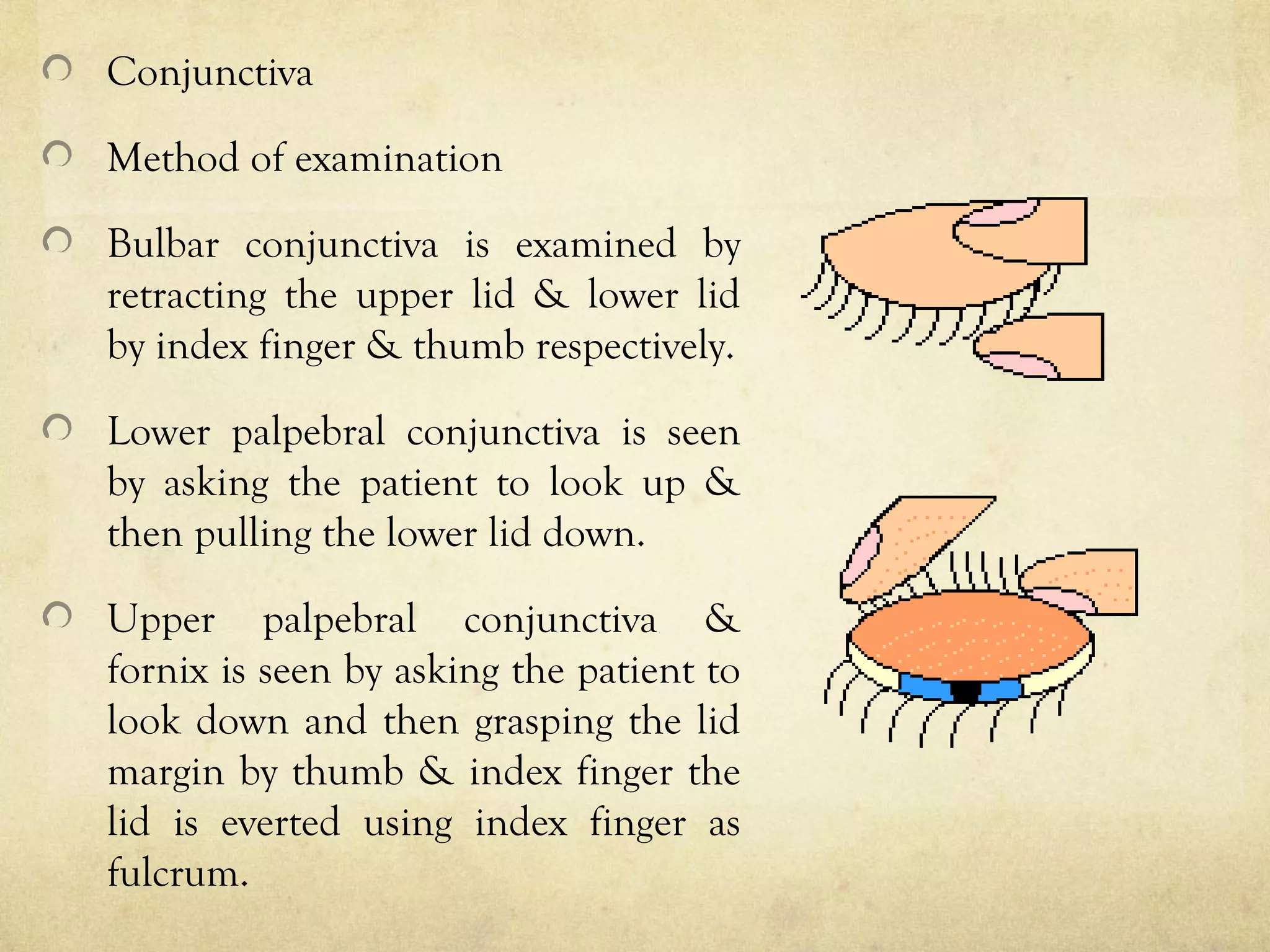 Conjunctiva
Method of examination
Bulbar conjunctiva is examined by
retracting the upper lid & lower lid
by index finger & thumb respectively.
Lower palpebral conjunctiva is seen
by asking the patient to look up &
then pulling the lower lid down.
Upper palpebral conjunctiva &
fornix is seen by asking the patient to
look down and then grasping the lid
margin by thumb & index finger the
lid is everted using index finger as
fulcrum.
 