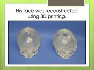 His face was reconstructed
using 3D printing.
 