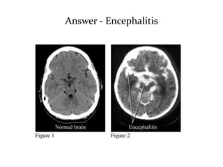Answer - Encephalitis 
 
