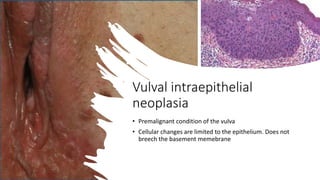 Vulval intraepithelial
neoplasia
• Premalignant condition of the vulva
• Cellular changes are limited to the epithelium. Does not
breech the basement memebrane
 