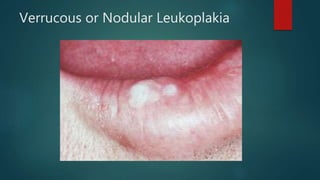 Verrucous or Nodular Leukoplakia
 