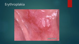 Erythroplakia
 