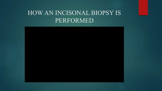 HOW AN INCISONAL BIOPSY IS
PERFORMED
 