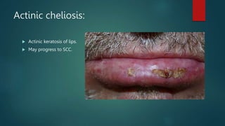 Actinic cheliosis:
 Actinic keratosis of lips.
 May progress to SCC.
 