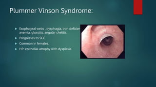 Plummer Vinson Syndrome:
 Esophageal webs , dysphagia, iron deficiency
anemia, glossitis, angular chelitis.
 Progresses to SCC.
 Common in females.
 HP: epithelial atrophy with dysplasia.
 