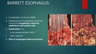 BARRETT ESOPHAGUS:
 Complication of chronic GERD
 Replacement of esophageal squamous
mucosa by metaplastic columnar
epithelium with goblet cells
 Subdivided in to
1. Long segment(classic form)
2. Short segment
 Risk of esophageal adenocarcinoma.
 