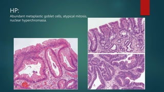 HP:
Abundant metaplastic goblet cells, atypical mitosis,
nuclear hyperchromasia.
 
