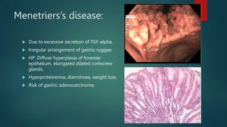 Menetriers’s disease:
 Due to excessive secretion of TGF-alpha.
 Irregular arrangement of gastric ruggae.
 HP: Diffuse hyperplasia of foveolar
epithelium, elongated dilated corkscrew
glands.
 Hypoproteinemia, diarrohoea, weight loss.
 Risk of gastric adenocarcinoma.
 