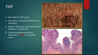 FAP
 AD, defect in APC gene.
 Numerous colorectal adenomas as
teenagers.
 Atleast 100 polyps are necessary for
diagnosis –Classic FAP
 Colorectal adenocarcinoma
develops in 100% in untreated
cases,
 