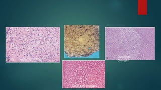 Small cell changes
Large cell changes
Dysplastic
changes
 