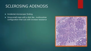 SCLEROSING ADENOSIS
 Incidental microscopic finding
 Gross:small mass with a disk like , multinodular
configuration that cuts with increase resistance
 