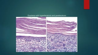 Dysplasia with hyperkeratosis and parakeratosis
 