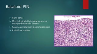 Basaloid PIN:
 Glans penis
 Morphologically High grade squamous
Intraepithelial lesions of cervix
 Squamous maturation is not characteristic
 P16 diffuse positive
 