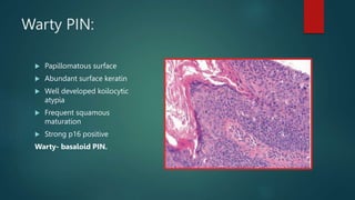 Warty PIN:
 Papillomatous surface
 Abundant surface keratin
 Well developed koilocytic
atypia
 Frequent squamous
maturation
 Strong p16 positive
Warty- basaloid PIN.
 