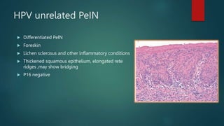 HPV unrelated PeIN
 Differentiated PeIN
 Foreskin
 Lichen sclerosus and other inflammatory conditions
 Thickened squamous epithelium, elongated rete
ridges ,may show bridging
 P16 negative
 