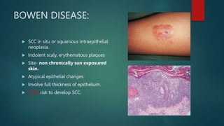 BOWEN DISEASE:
 SCC in situ or squamous intraepithelial
neoplasia.
 Indolent scaly, erythematous plaques
 Site- non chronically sun exposured
skin.
 Atypical epithelial changes.
 Involve full thickness of epithelium.
 3-5% risk to develop SCC.
 