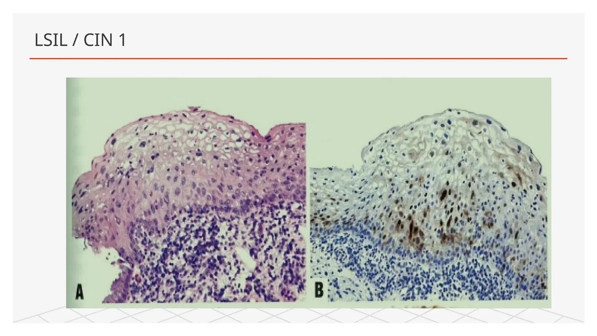 PREMALIGNANT LESIONS OF THE UTERINE CERVIX PPT.pptx