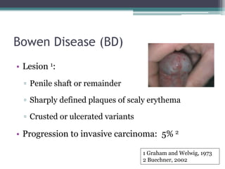 Premalignant penile lesions.pptx