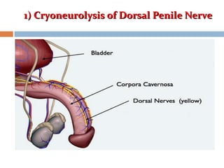 1) Cryoneurolysis of Dorsal Penile Nerve1) Cryoneurolysis of Dorsal Penile Nerve
 