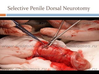 Selective Penile Dorsal Neurotomy
 