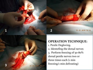 1 2
3
OPERATION TECHNIQUE:
1. Penile Degloving.
2. Identefing the dorsal nerves
3. Perform freezing of 50-80%
dorsal penile nerves two or
three times each (1 min
freezing/1 min defrosting)
 