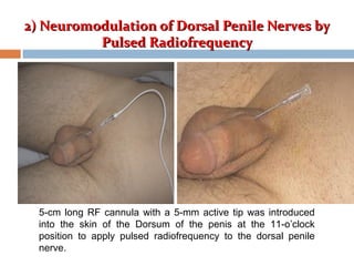 2) Neuromodulation of Dorsal Penile Nerves by2) Neuromodulation of Dorsal Penile Nerves by
Pulsed RadiofrequencyPulsed Radiofrequency
5-cm long RF cannula with a 5-mm active tip was introduced
into the skin of the Dorsum of the penis at the 11-o’clock
position to apply pulsed radiofrequency to the dorsal penile
nerve.
 