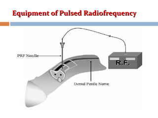 Equipment of Pulsed RadiofrequencyEquipment of Pulsed Radiofrequency
 