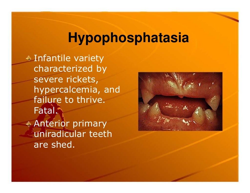 Premature exfoliation of primary teeth