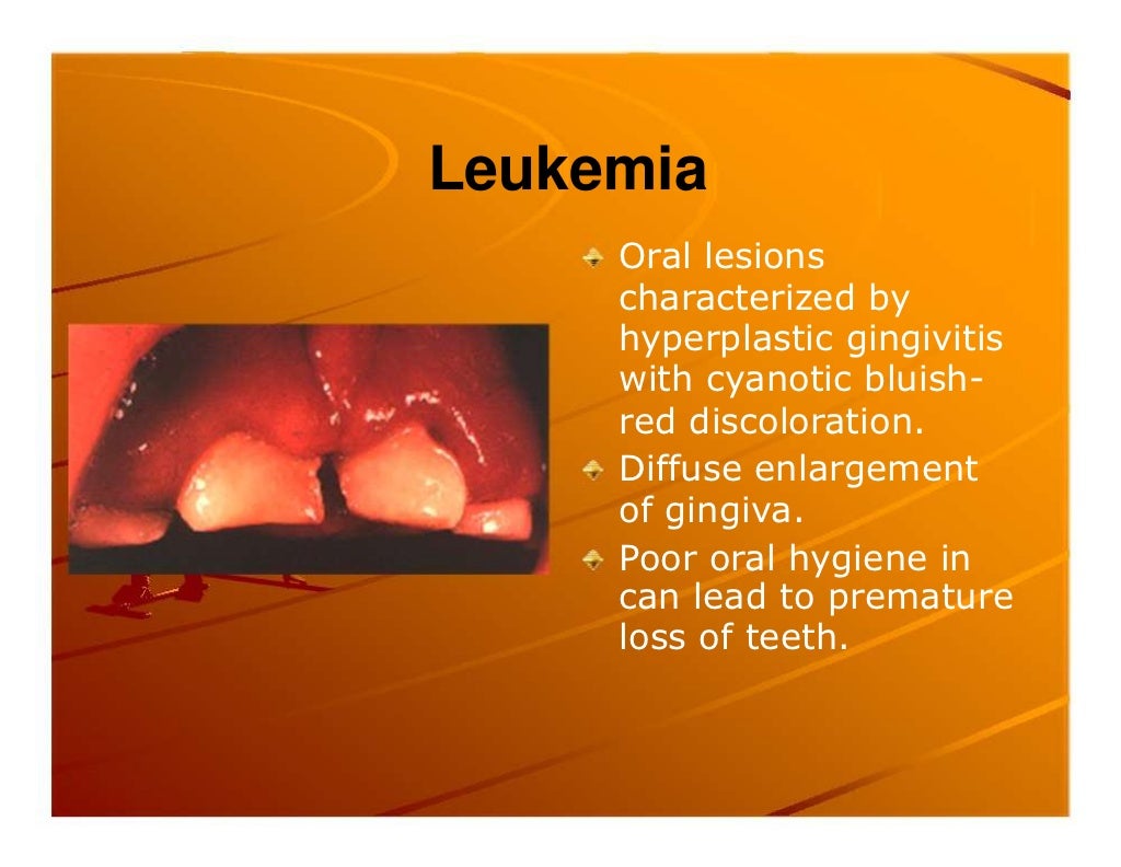Premature exfoliation of primary teeth