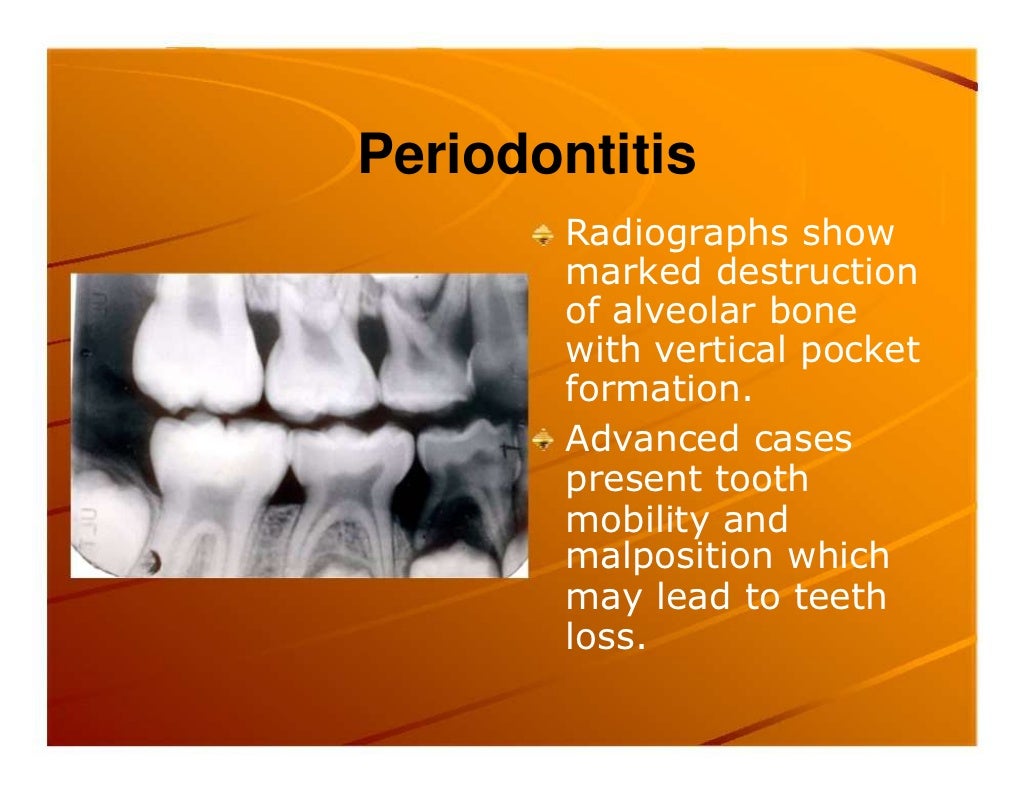 Premature exfoliation of primary teeth