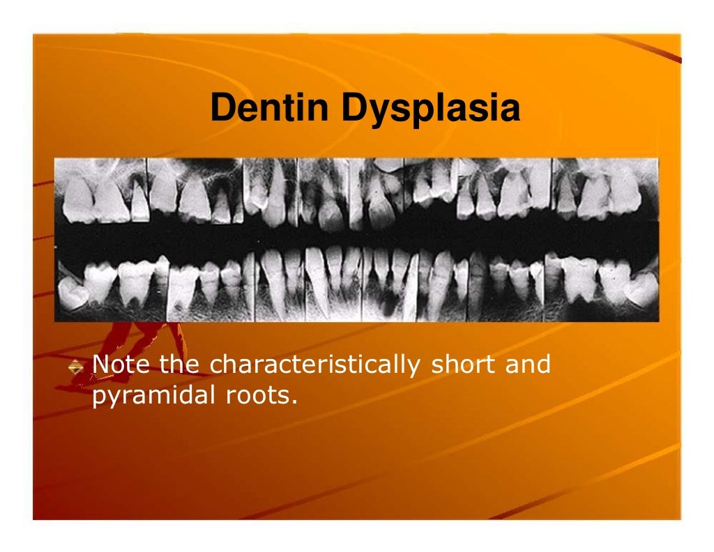 Premature exfoliation of primary teeth