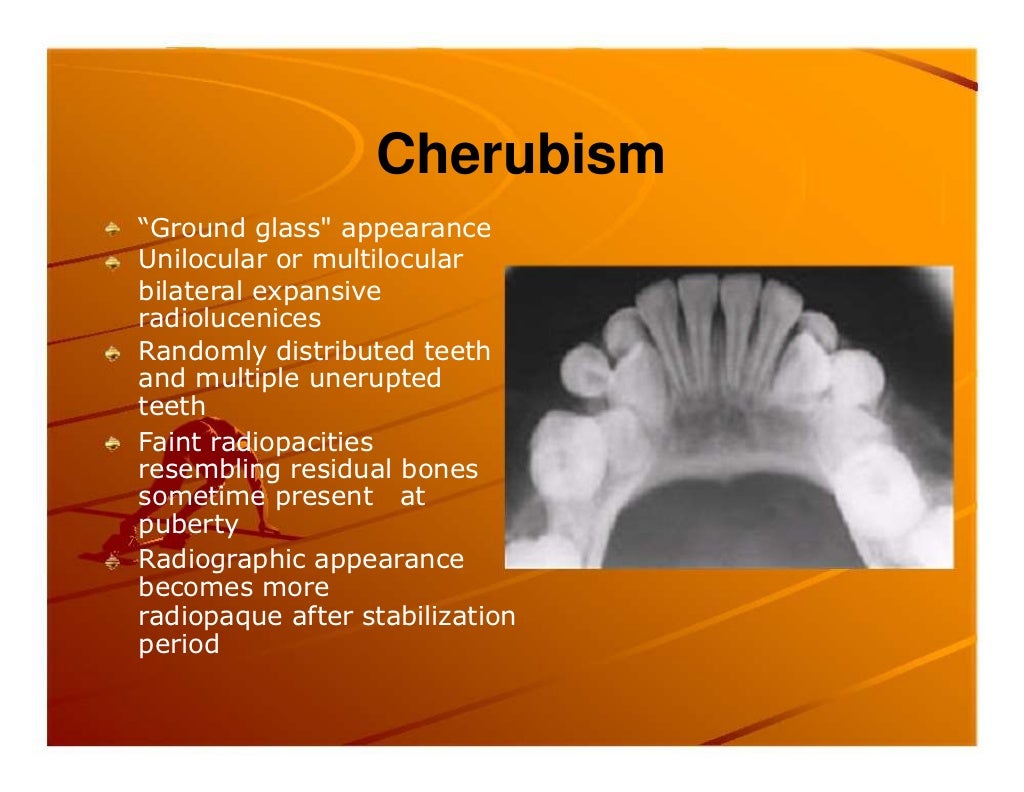 Premature exfoliation of primary teeth