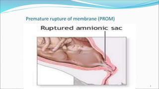 Premature rupture of membrane (PROM)
1
 