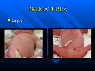PREMATUREZ La piel 