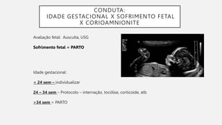 CONDUTA:
IDADE GESTACIONAL X SOFRIMENTO FETAL
X CORIOAMNIONITE
Avaliação fetal: Ausculta, USG
Sofrimento fetal = PARTO
Idade gestacional:
< 24 sem – individualizar
24 – 34 sem – Protocolo – internação, tocólise, corticoide, atb
>34 sem = PARTO
 