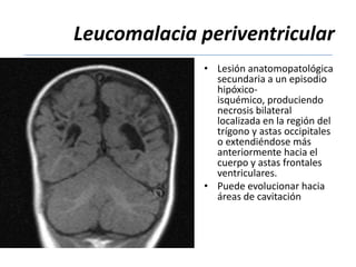 Leucomalacia periventricular
             • Lesión anatomopatológica
               secundaria a un episodio
               hipóxico-
               isquémico, produciendo
               necrosis bilateral
               localizada en la región del
               trígono y astas occipitales
               o extendiéndose más
               anteriormente hacia el
               cuerpo y astas frontales
               ventriculares.
             • Puede evolucionar hacia
               áreas de cavitación
 