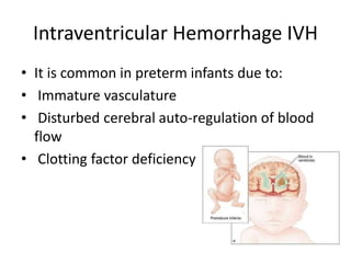 Intraventricular Hemorrhage IVH
• It is common in preterm infants due to:
• Immature vasculature
• Disturbed cerebral auto-regulation of blood
flow
• Clotting factor deficiency
 