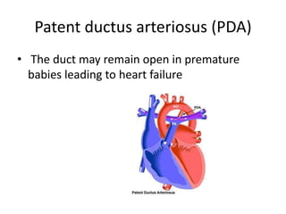 Patent ductus arteriosus (PDA)
• The duct may remain open in premature
babies leading to heart failure
 