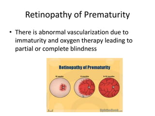 Retinopathy of Prematurity
• There is abnormal vascularization due to
immaturity and oxygen therapy leading to
partial or complete blindness
 