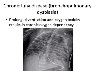 Chronic lung disease (bronchopulmonary
dysplasia)
• Prolonged ventilation and oxygen toxicity
results in chronic oxygen dependency
 