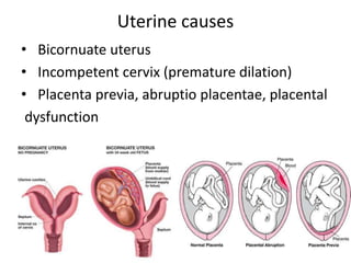 Uterine causes
• Bicornuate uterus
• Incompetent cervix (premature dilation)
• Placenta previa, abruptio placentae, placental
dysfunction
 