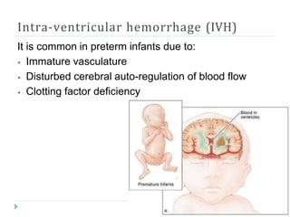 Intra-ventricular hemorrhage (IVH)
It is common in preterm infants due to:
⦁ Immature vasculature
⦁ Disturbed cerebral auto-regulation of blood flow
⦁ Clotting factor deficiency
 