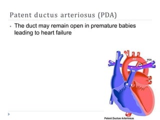Patent ductus arteriosus (PDA)
⦁ The duct may remain open in premature babies
leading to heart failure
 