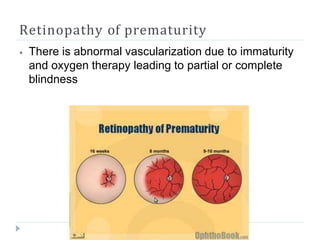 Retinopathy of prematurity
⦁ There is abnormal vascularization due to immaturity
and oxygen therapy leading to partial or complete
blindness
 