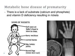 Metabolic bone disease of prematurity
⦁ There is a lack of substrate (calcium and phosphate)
and vitamin D deficiency resulting in rickets
 