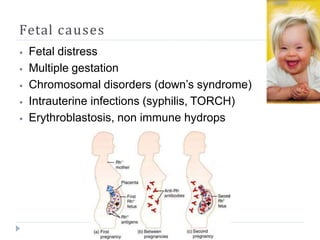 Fetal causes
⦁ Fetal distress
⦁ Multiple gestation
⦁ Chromosomal disorders (down’s syndrome)
⦁ Intrauterine infections (syphilis, TORCH)
⦁ Erythroblastosis, non immune hydrops
 