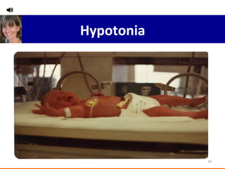Hypotonia 