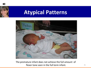 The premature infant does not achieve the full amount  of  flexor tone seen in the full term infant. Atypical Patterns 